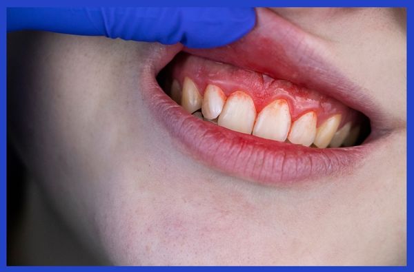 #8 Bleeding Gums Are Normal