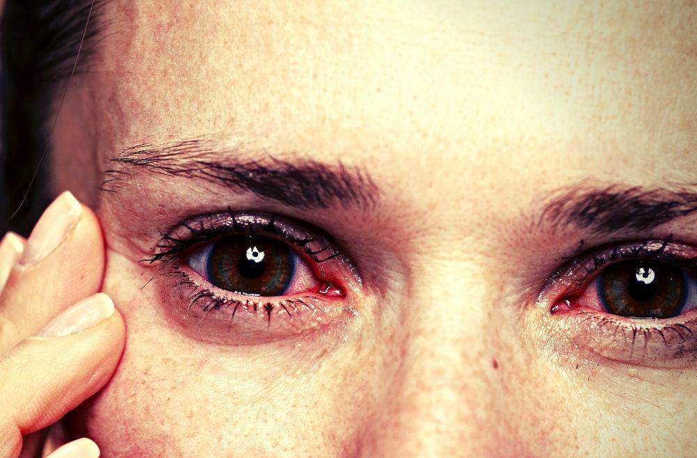 Woman with herpes eye disease