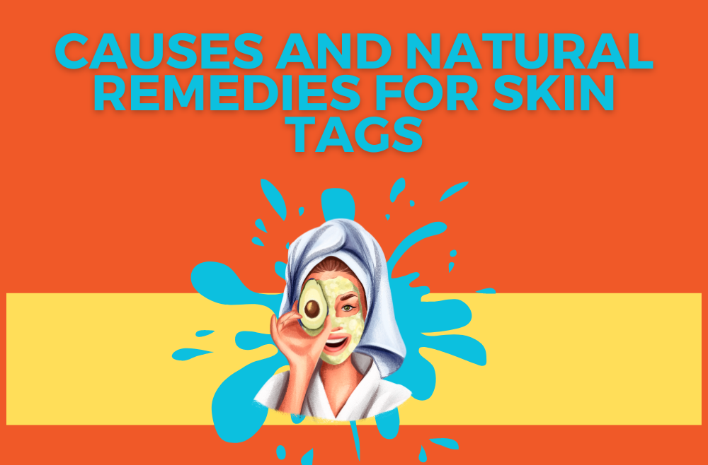 Banner that reads Causes and Natural Remedies for Skin Tags